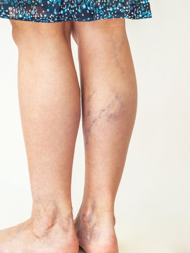 Read more about the article BEST YOGA FOR VARICOSE VEINS