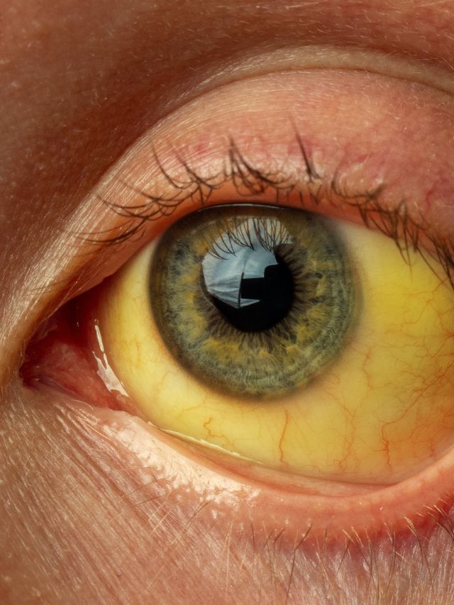 Read more about the article YOGA POSES FOR HEPATITIS AND ITS BENEFIT