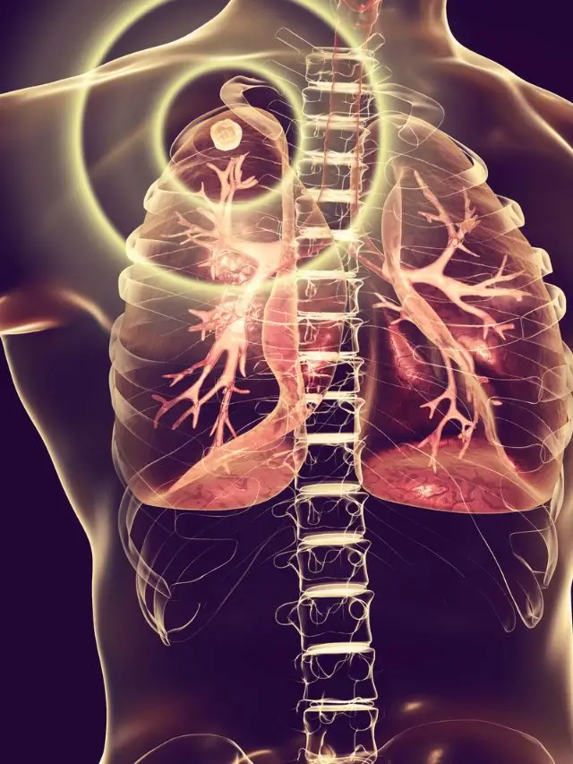 Read more about the article YOGA POSES FOR TUBERCULOSIS FOR ADULTS